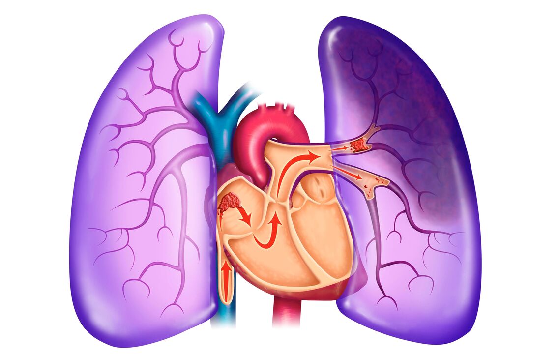 hipertensiune pulmonara